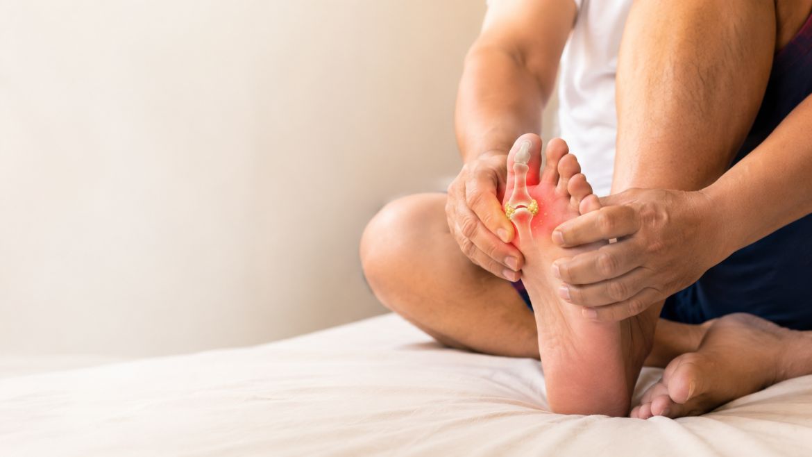 Gout (Inflammatory Joint Disorder)
